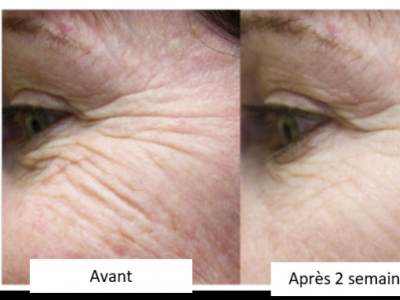 Skin aging - Evolution